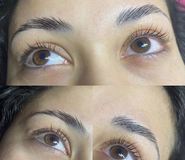 Brow lift voorbeeld 1